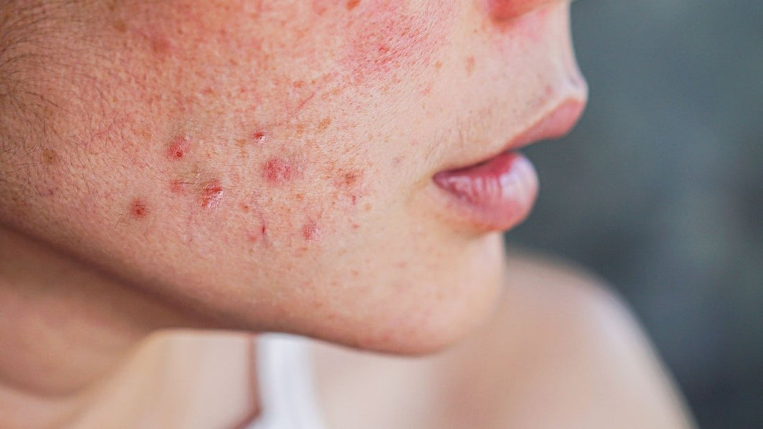 Understanding and Managing Hormonal Acne: An In-Depth Guide - Lakinza