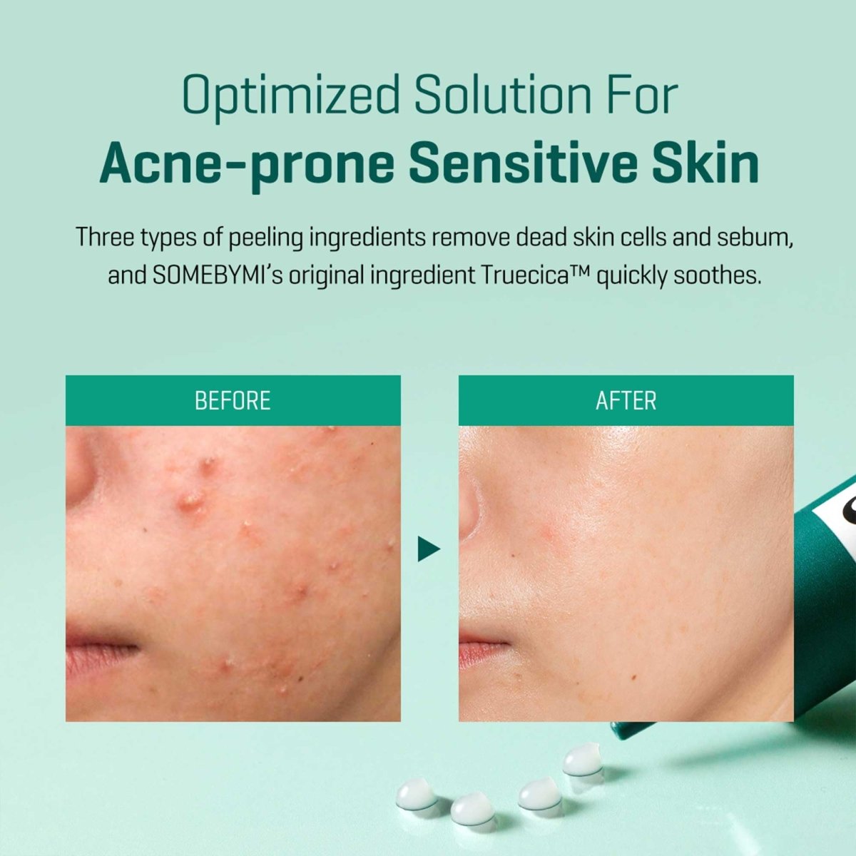 Acne - Prone Skin Ultimate Skincare Routine Korean Skincare